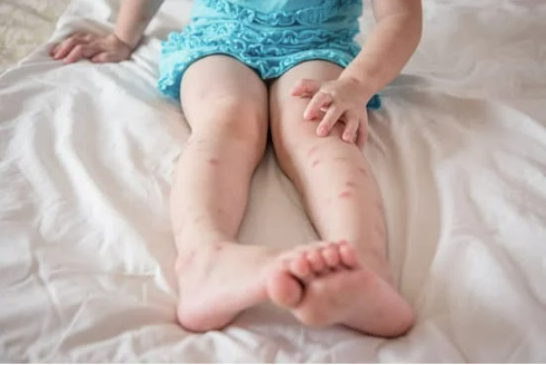 HOW LONG DO BED BUG BITES ITCH?