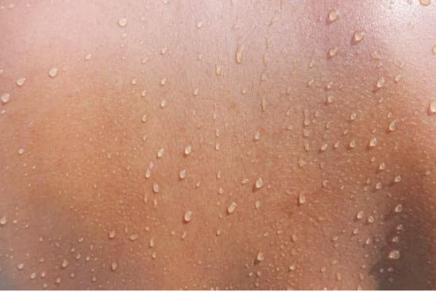 CAN BED BUGS GO INSIDE YOUR BODY?