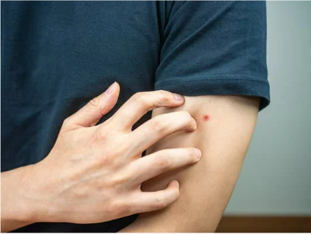 DO BED BUGS LEAVE SCABS?