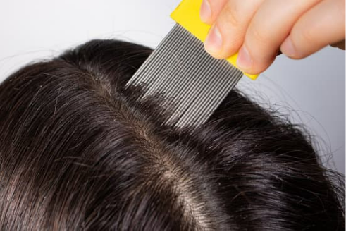 BED BUGS VS. LICE