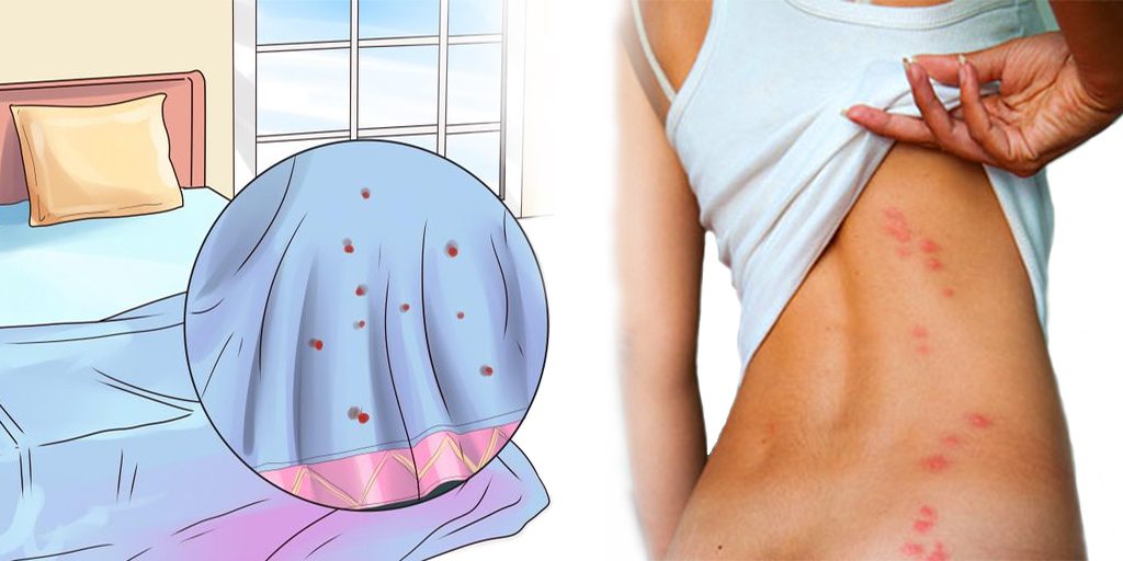 Do bed bugs leave welts?