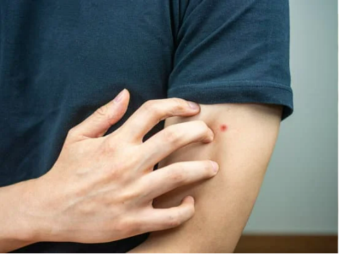 HOW LONG DO BED BUGS BITE LAST?