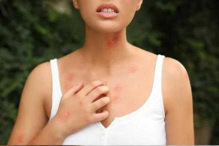 Will bed bugs bite your face?