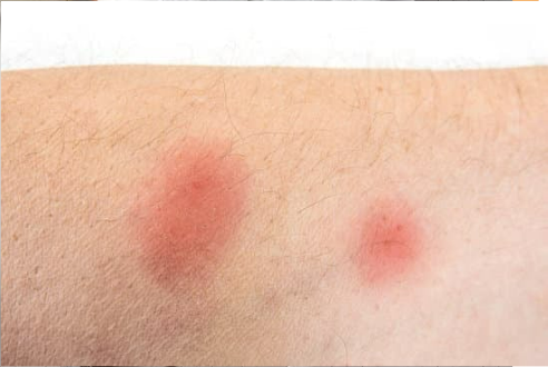 CAN YOU FEEL A BEDBUG BITE?