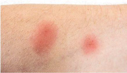 Do bed bugs leave bite marks?