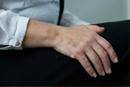 Do bed bugs leave blisters?