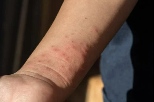 WHERE DO BED BUGS BITE YOU THE MOST