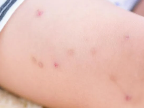 Bed Bug Infestation Problem