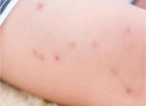 BED BUG BITES