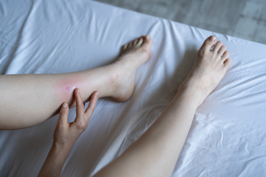 Will bed bugs leave a blister?