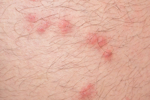 How long do flea bites last?