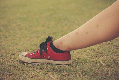 Why do the bed bugs only bite me